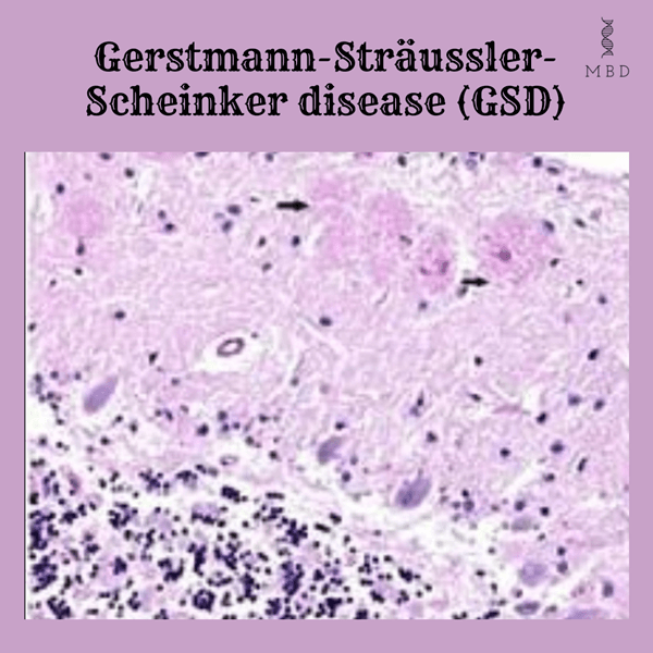 Gerstmann-Sträussler-Scheinker disease (GSD)