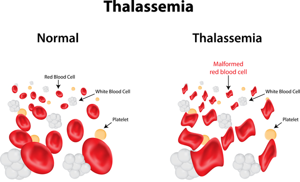 Alpha thalassemia