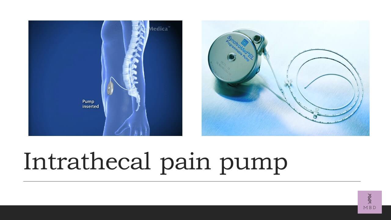 intrathecal pain pump surgery